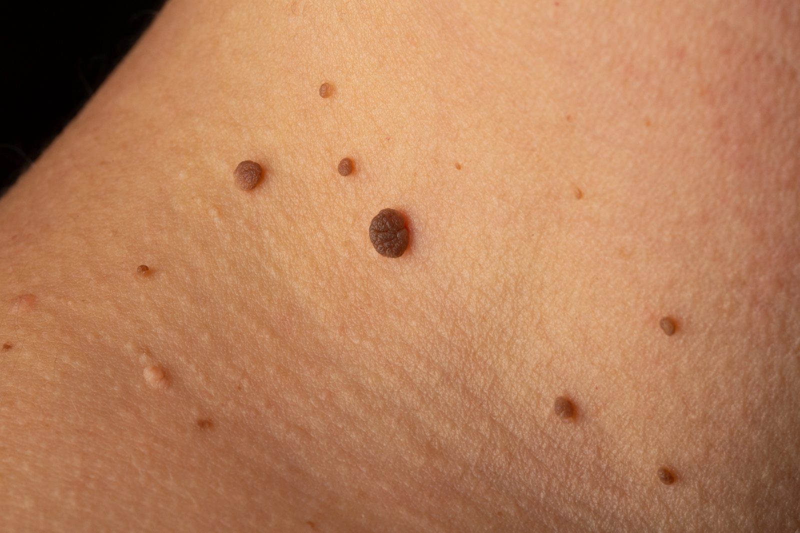 Kožna znamenja te naučijo, da telo ves čas komunicira